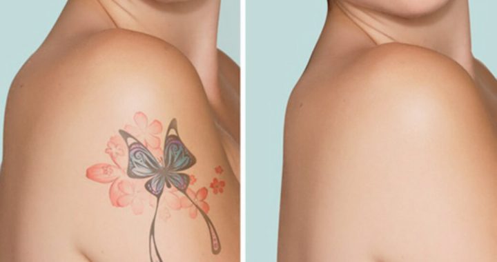 Things to consider before laser tattoo removal